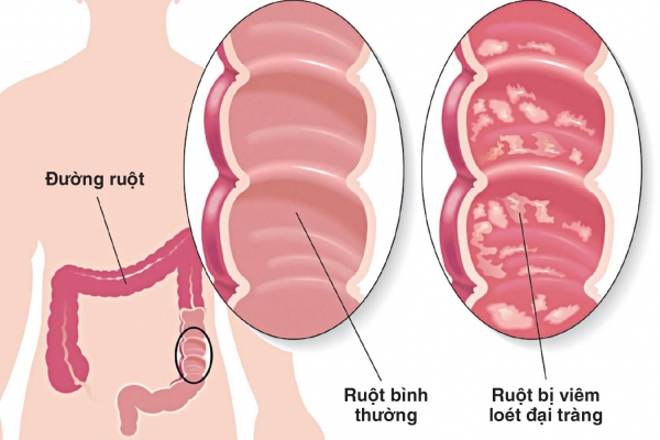 Ulcerative colitis - Ảnh minh họa 3