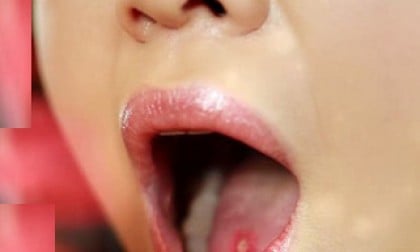 Viêm miệng do virus Herpes - Ảnh minh họa 4