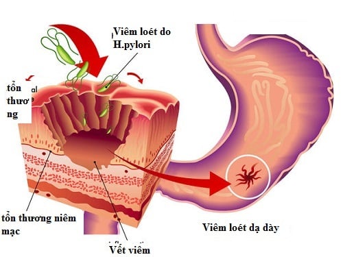 Viêm dạ dày - Ảnh minh họa 2