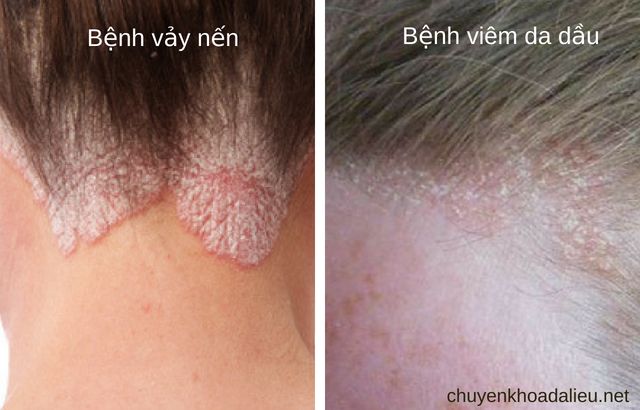Viêm da dầu - Ảnh minh họa 4