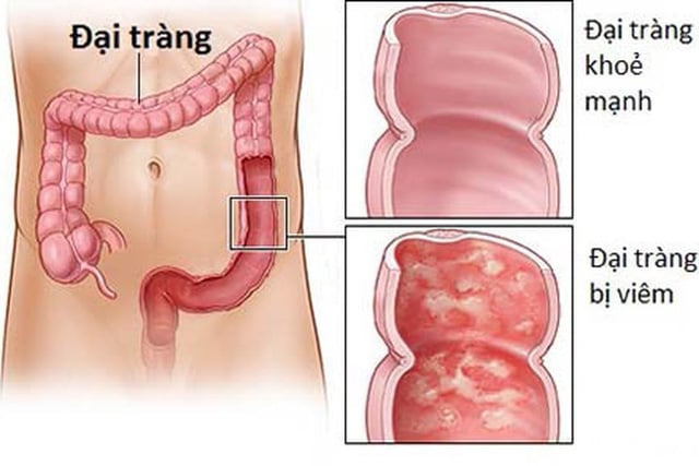 Viêm loét đại tràng - Ảnh minh họa 2