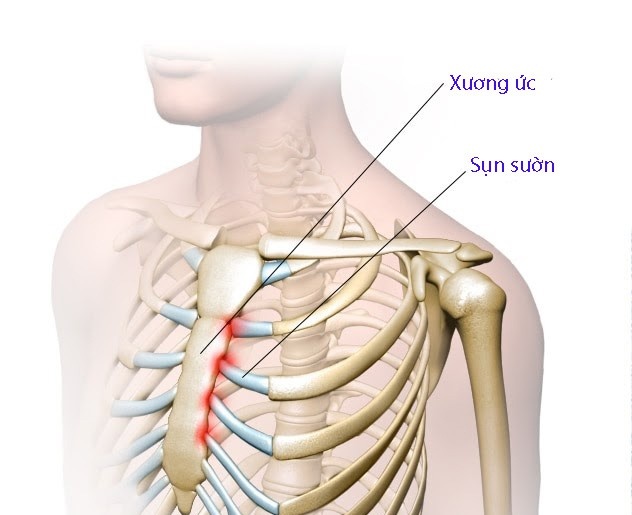 Viêm sụn sườn - Ảnh minh họa 2