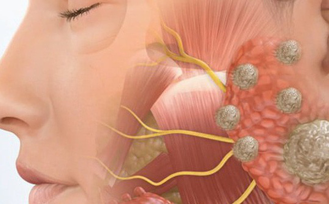 Ung thư tuyến nước bọt - Ảnh minh họa 2