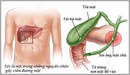 Ung thư ống mật và túi mật - Ảnh minh họa 2