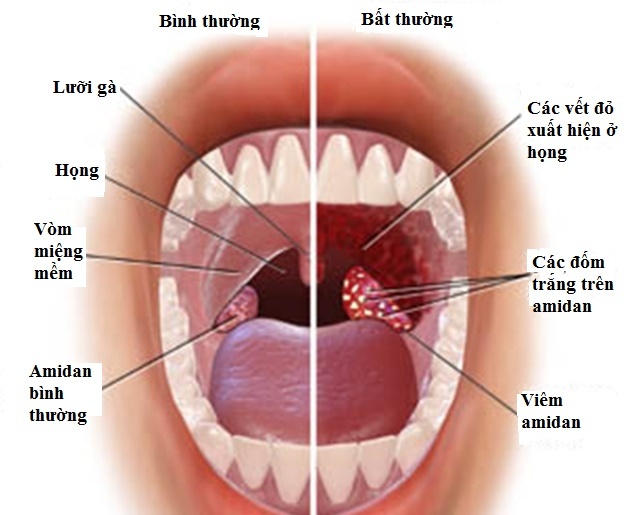 Viêm Amiđan - Ảnh minh họa 2