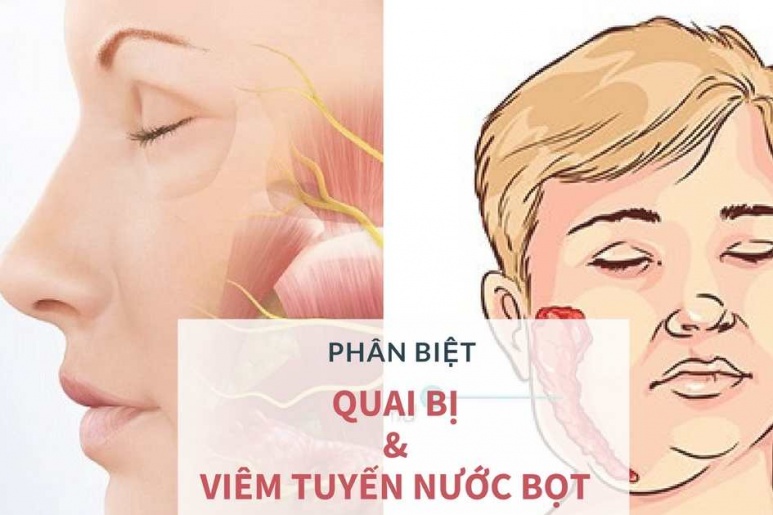 Viêm tuyến nước bọt - Ảnh minh họa 3