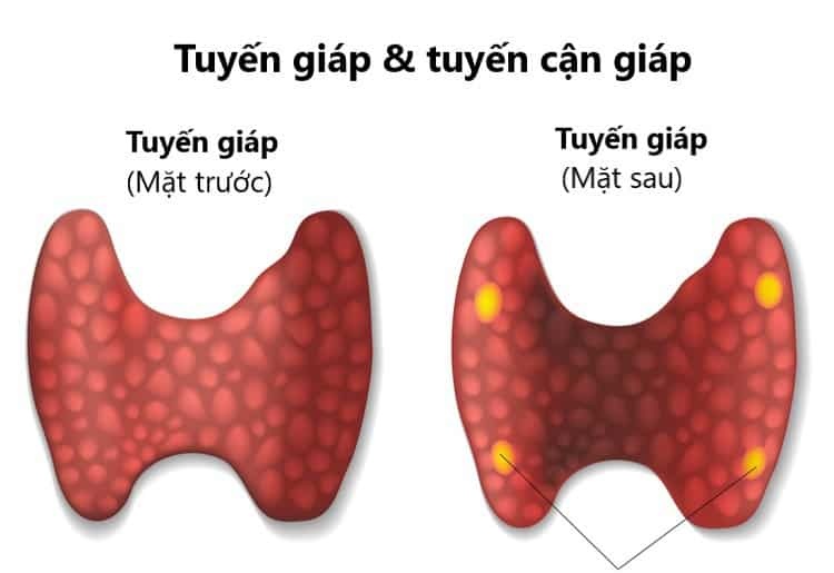 Ung thư tuyến cận giáp - Ảnh minh họa 3