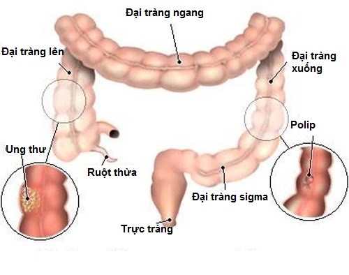 U đại tràng - Ảnh minh họa 1