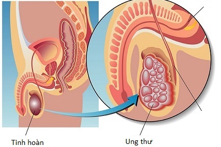 Cancer of the testicles - Ảnh minh họa 1