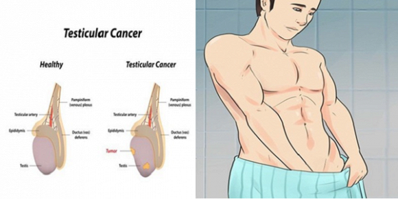 Cancer of the testicles - Ảnh minh họa 4