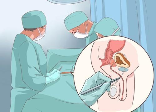 Cancer of the testicles - Ảnh minh họa 5