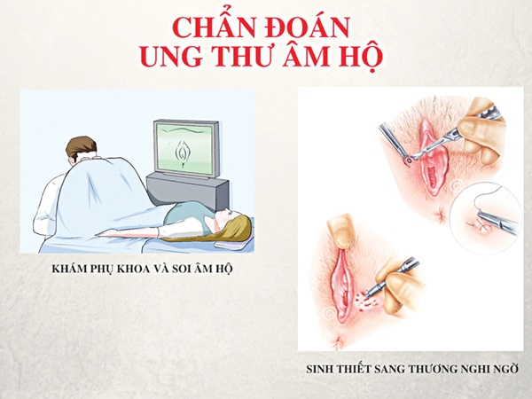 Ung thư âm hộ - Ảnh minh họa 3