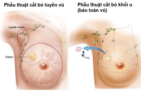 Ung thư biểu mô tuyến vú xâm lấn (IDC) - Ảnh minh họa 4