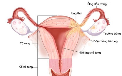 Ung thư ống dẫn trứng - Ảnh minh họa 3