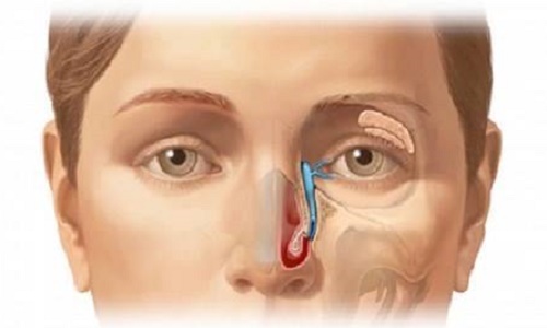 Ung thư biểu mô xoang hàm trên - Ảnh minh họa 4