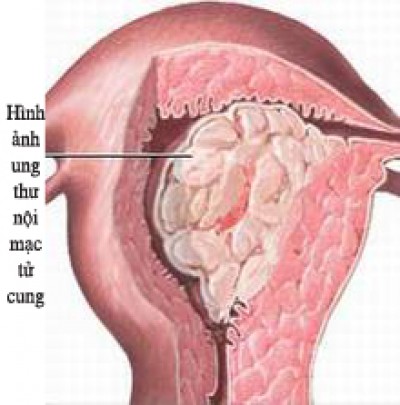 Ung thư nội mạc tử cung - Ảnh minh họa 4