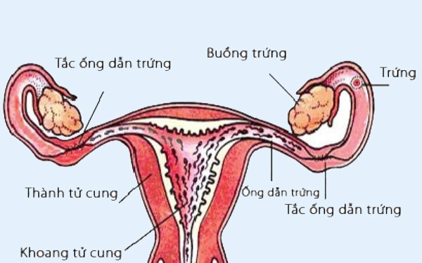 Ung thư ống dẫn trứng - Ảnh minh họa 4