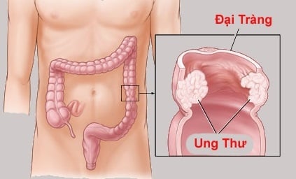 Viêm loét đại tràng - Ảnh minh họa 4
