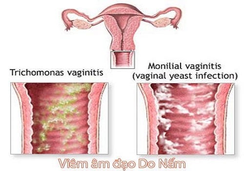 Viêm âm đạo do nấm - Ảnh minh họa 4