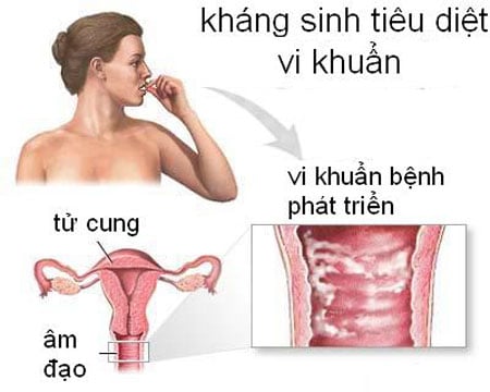 Viêm âm đạo do vi khuẩn - Ảnh minh họa 4