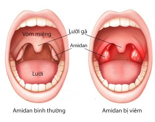 Viêm Amiđan - Ảnh minh họa 4