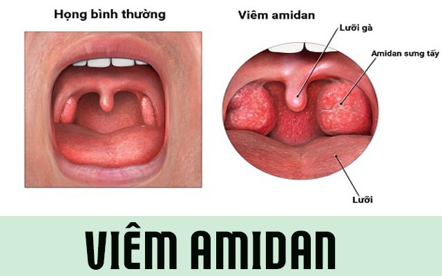 Viêm Amiđan - Ảnh minh họa 3