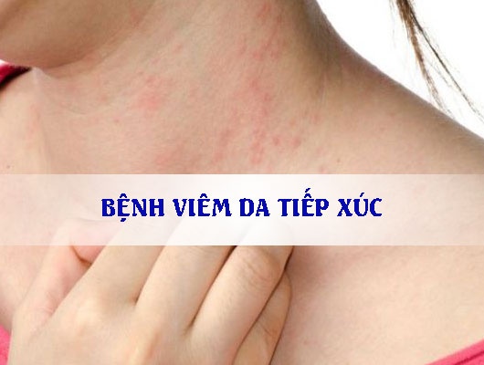 Viêm da tiếp xúc - Ảnh minh họa 4