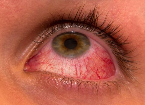 Uveitis - Ảnh minh họa 3