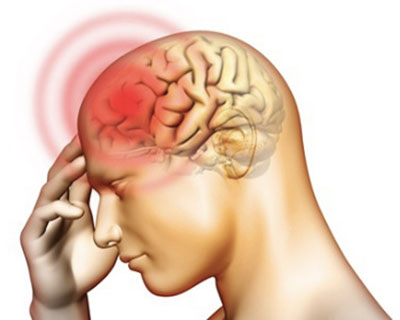 Viêm màng não - Ảnh minh họa 4