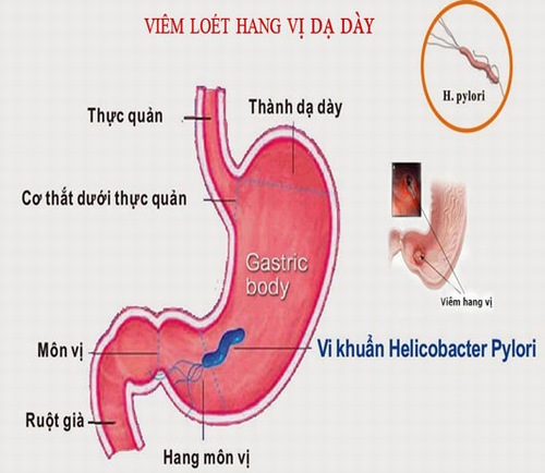 Viêm xung huyết hang vị dạ dày - Ảnh minh họa 4