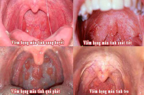 Viêm họng - Ảnh minh họa 4