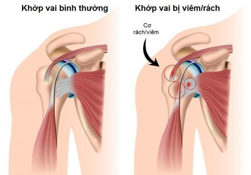 Causalgia - Ảnh minh họa 1