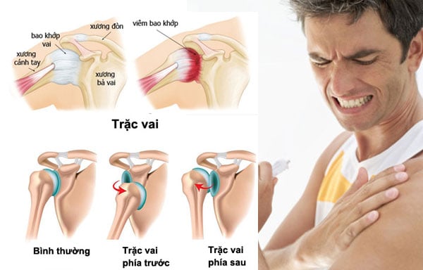 Causalgia - Ảnh minh họa 3