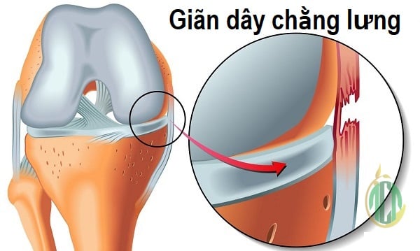 Causalgia - Ảnh minh họa 4