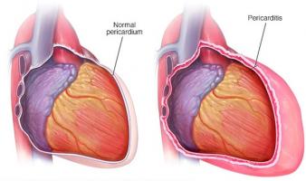 Viêm màng ngoài tim - Ảnh minh họa 2