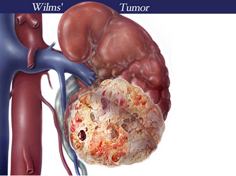 Wilms tumor - Ảnh minh họa 2