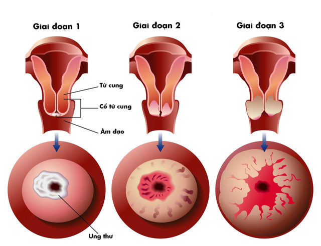 Cervical Dysplasia - Ảnh minh họa 1