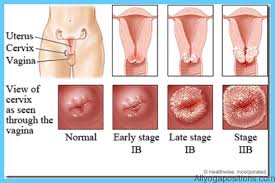 Cervical Dysplasia - Ảnh minh họa 2