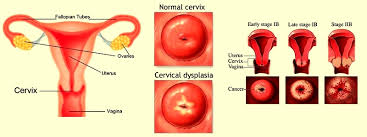 Cervical Dysplasia - Ảnh minh họa 3