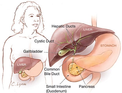 Cholecystitis - Ảnh minh họa 2