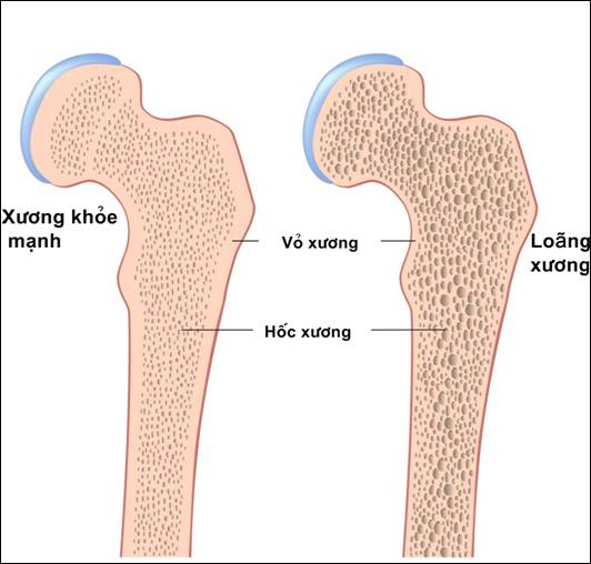 Xốp xương - Ảnh minh họa 4