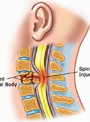 Chèn ép tủy sống - Ảnh minh họa 2