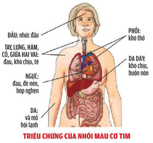 Chứng nhồi máu cơ tim - Ảnh minh họa 2