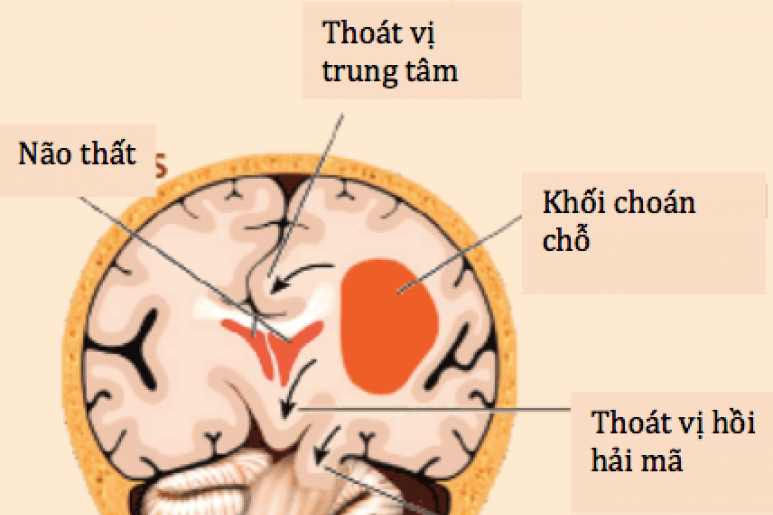 Cerebral venous thrombosis - Ảnh minh họa 2