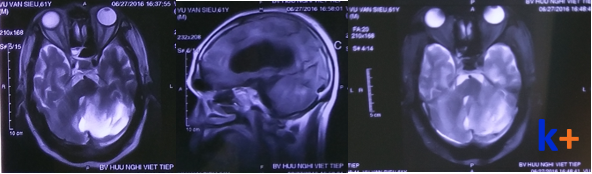 Cerebral venous thrombosis - Ảnh minh họa 3