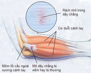 Chứng đau khuỷu tay tennis - Ảnh minh họa 2