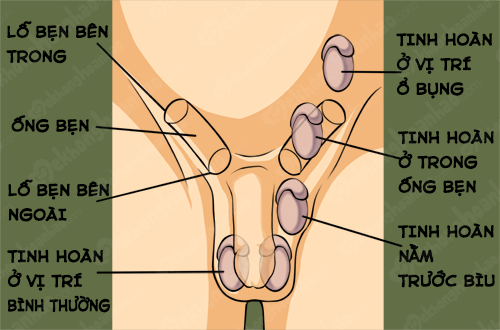 Cryptorchidism - Ảnh minh họa 1