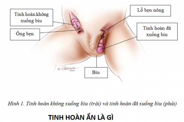 Cryptorchidism - Ảnh minh họa 3