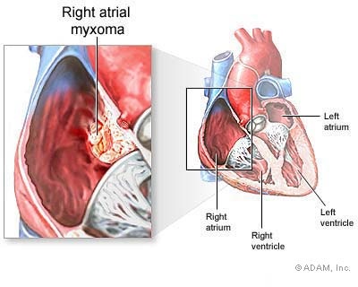 Cardiac Tumors - Ảnh minh họa 1