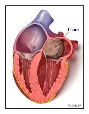 Cardiac Tumors - Ảnh minh họa 2